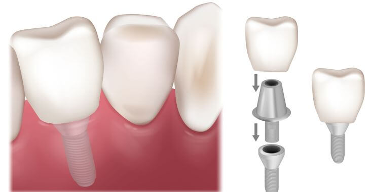 tooth implant process